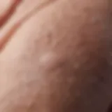 Close-up of vesicles on skin