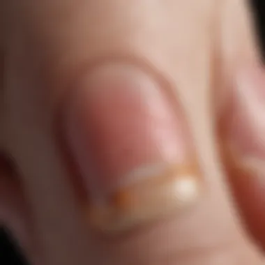 Pathophysiology of Nail Psoriasis Diagram illustrating the underlying pathophysiology of nail psoriasis.