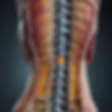 An anatomical diagram of the lumbar spine highlighting spinal stenosis