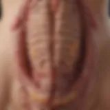 Illustration of the colonic mucosa affected by ulcerative colitis