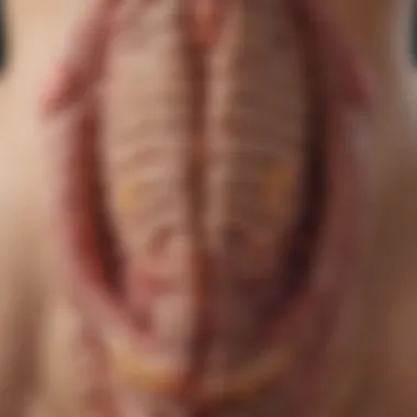 Illustration of the colonic mucosa affected by ulcerative colitis
