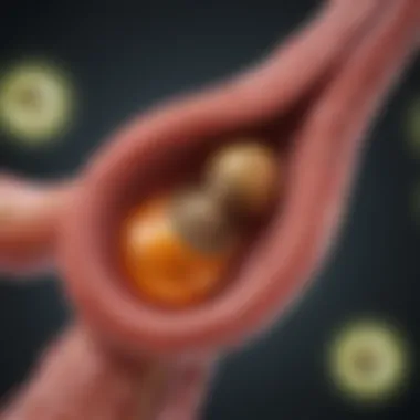 Visual Representation of Gallstones in Bile Duct Illustration of gallstones in the bile duct